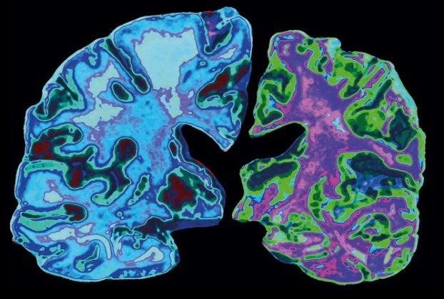 Find signs of why Alzheimer's is stronger in women