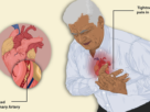 What are the differences between "cardiac arrest" and "heart attack"?
