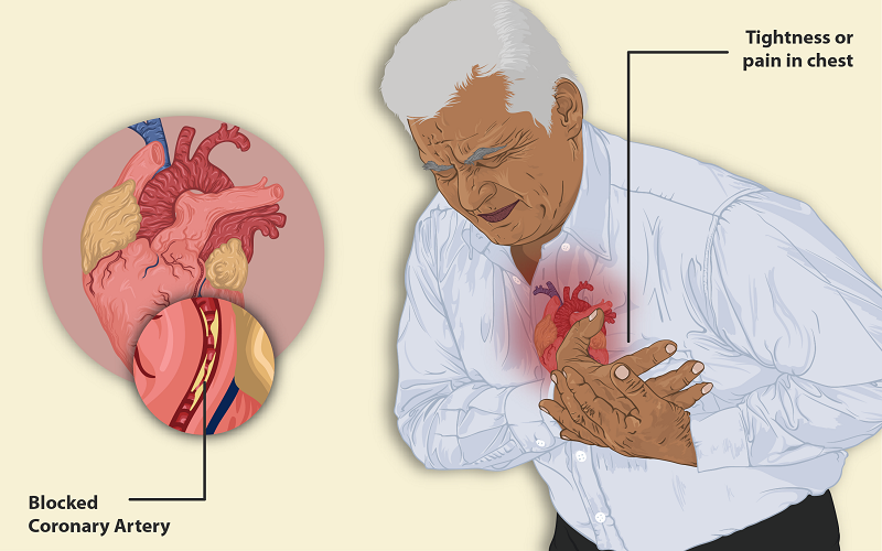 What are the differences between "cardiac arrest" and "heart attack"?