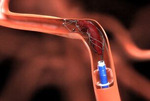 Endovascular Devices Market