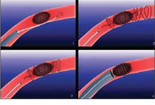 Mechanical Thrombectomy Devices
