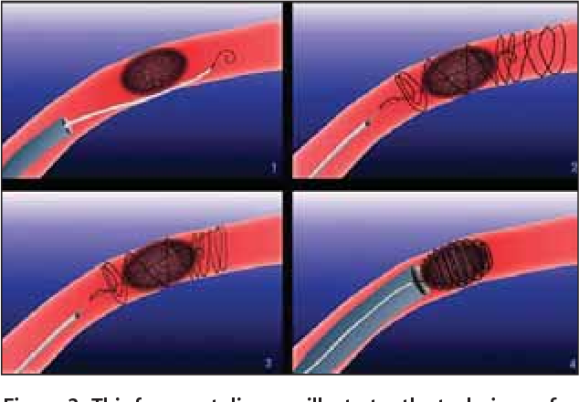Mechanical Thrombectomy Devices