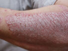 Psoriasis Treatment Market