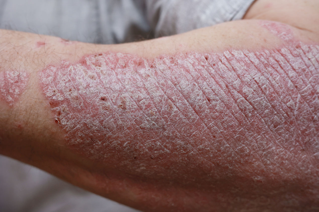 Psoriasis Treatment Market