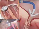 Tricuspid Valve Repair