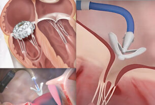 Tricuspid Valve Repair