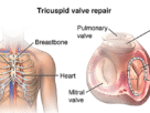 Tricuspid Valve Repair