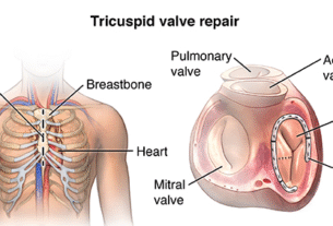 Tricuspid Valve Repair