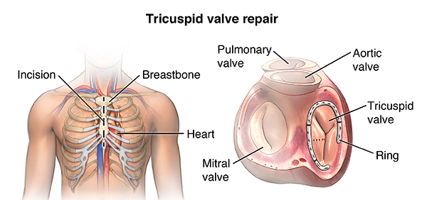 Tricuspid Valve Repair